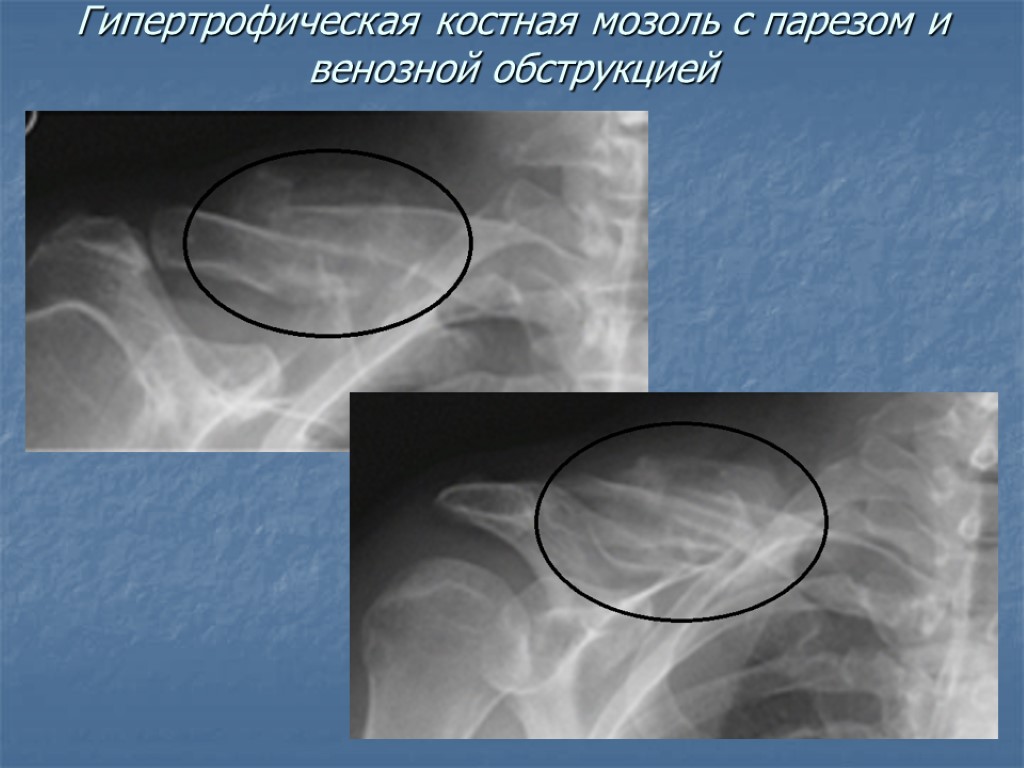 Гипертрофическая костная мозоль с парезом и венозной обструкцией